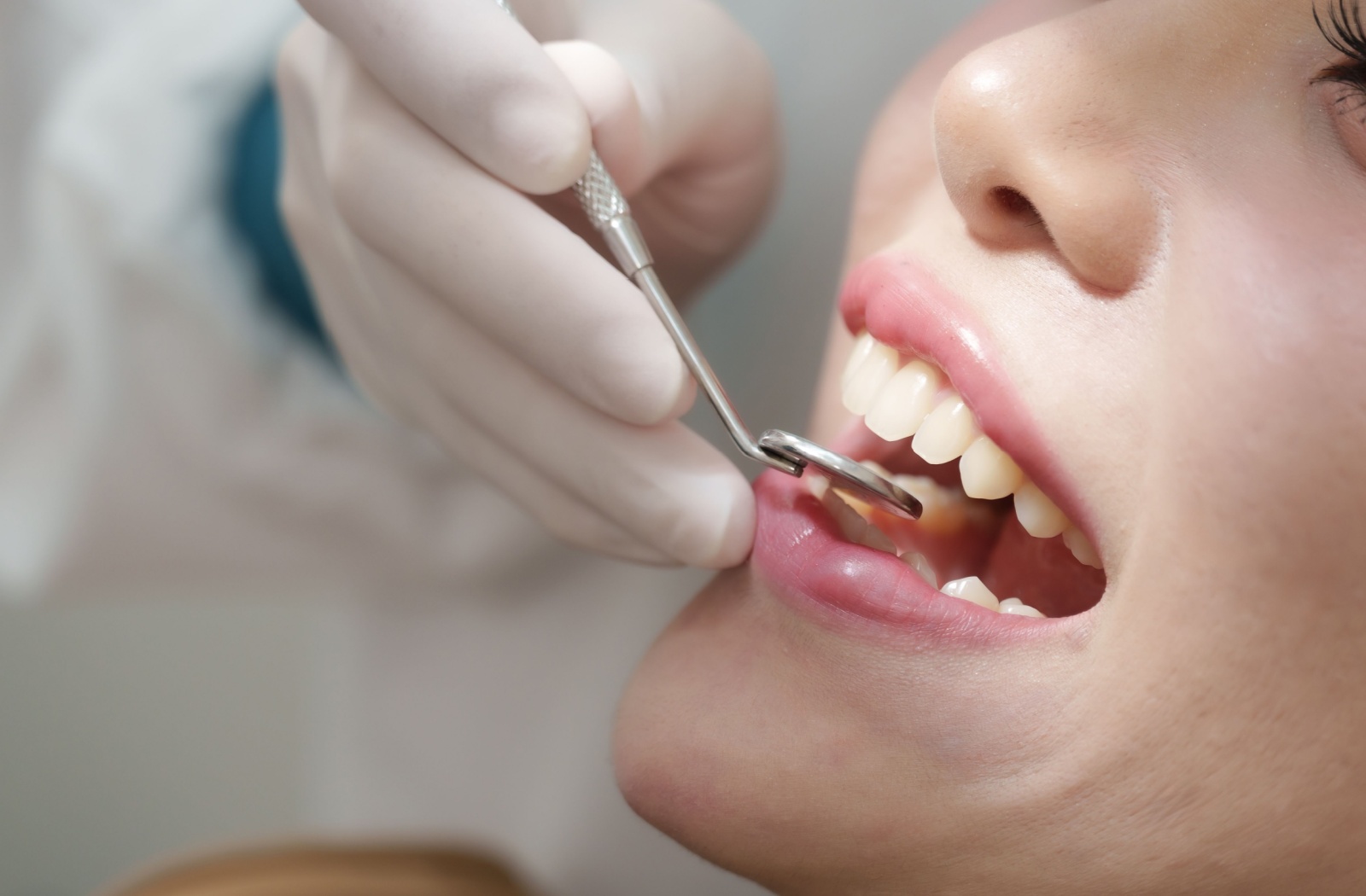 A close up of a persons mouth as a dentist uses a specialized mirror to see behind their front teeth